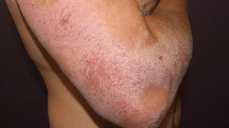 Atopic Dermatitis