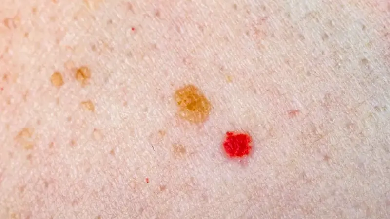 Cherry Angiomas