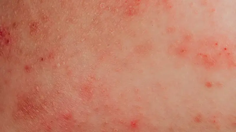 Dermatitis