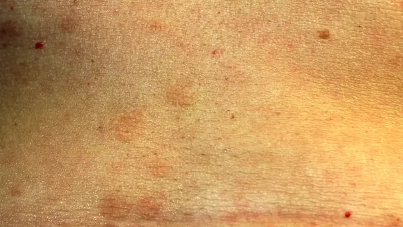 Lichen Planus