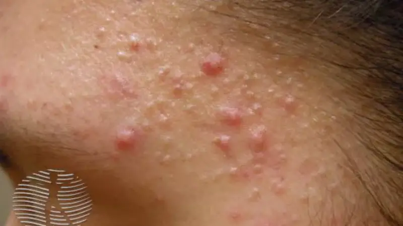 Pimples (Acne Vulgaris)