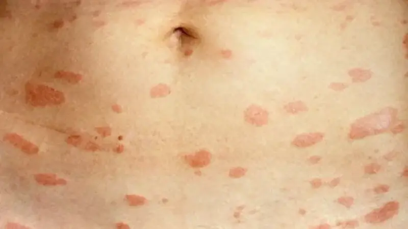 Pityriasis Rosea