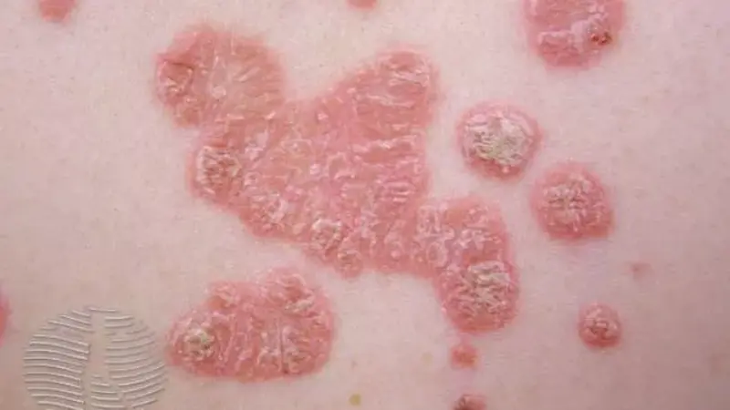 Psoriasis